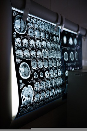 MRI Scan